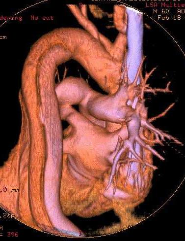 CT aorta God geometrisk (romlig)