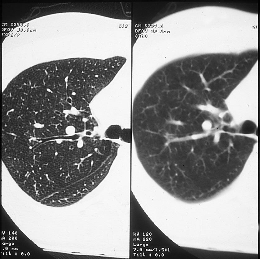 CT aorta, teknikk Tilstrekkelig mengde kontrastmiddel iv.