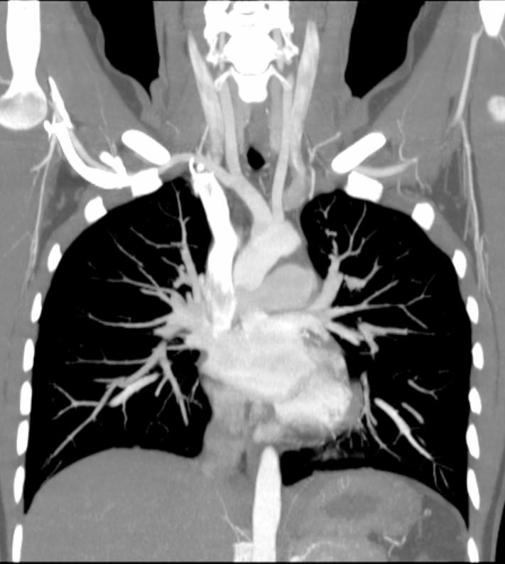 MultiDetektor-CT MDCT 1 simultant snitt 64 simultane