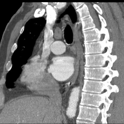 CT aorta