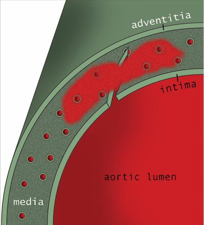 Intramuralt hematom