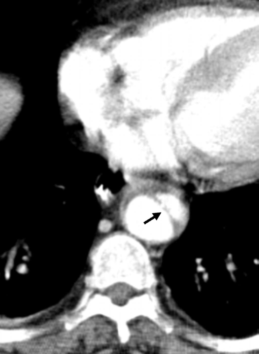 Intramuralt hematom