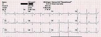 Elektrokardiogram (EKG) http://www.