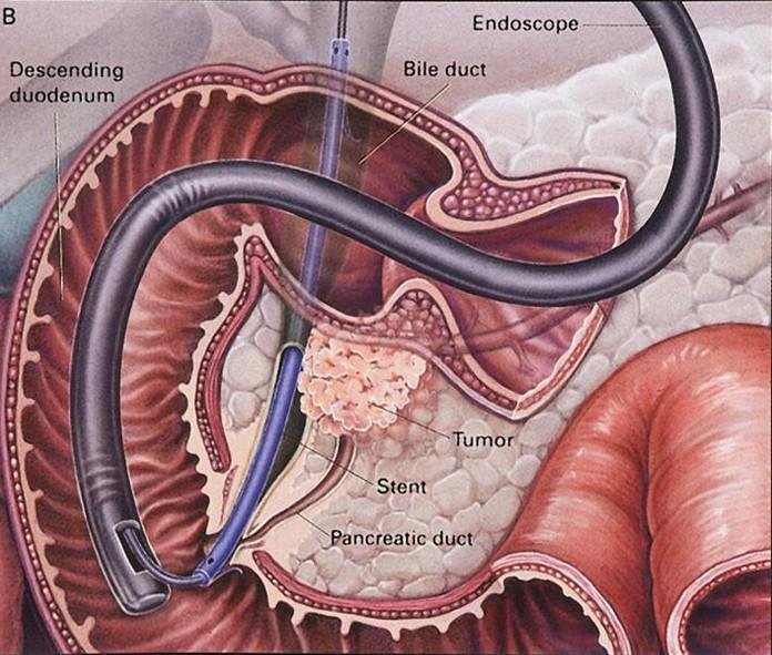 ERCP (endoskopisk