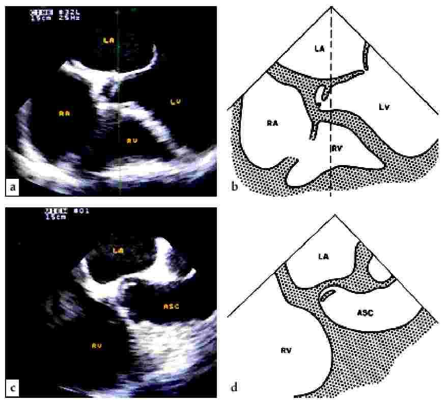 TEE, aorta ascendens og atrieseptm Kortakse