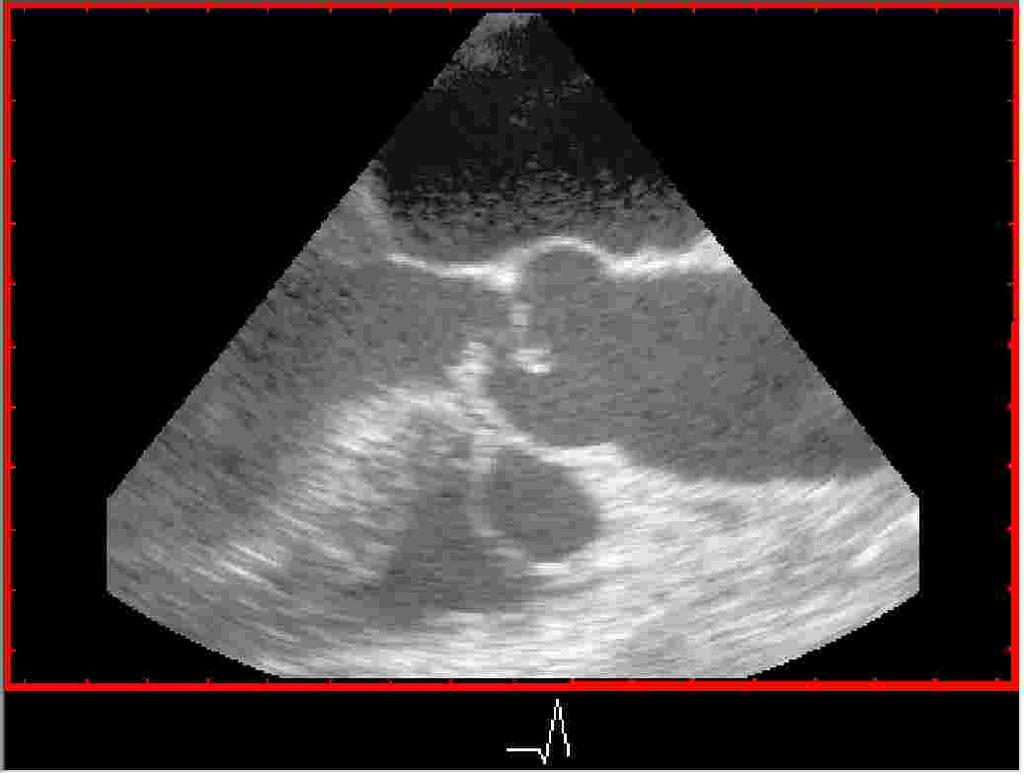 Aortaklaff-endokarditt, abscess Ca.