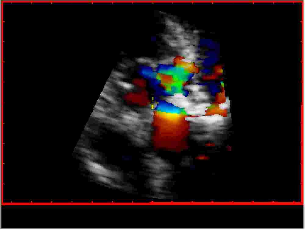 Perfndert abscess i aortarot (SAX)