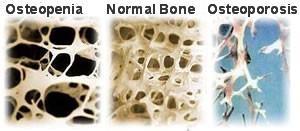 Hvorfor er osteoporose viktig for sykepleiere som jobber med revmatologi Inflammatoriske revmatiske sykdommer gir økt risiko for