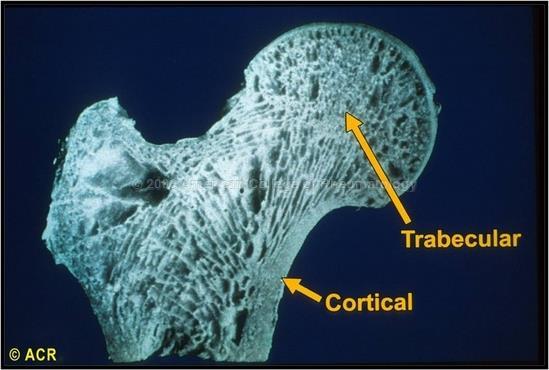 Tap av benmasse Trabekulært ben 10-20% tap i trabekulært ben første 6 mnd