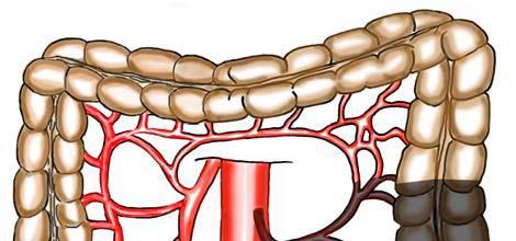 Cancer i descendens: Venstresidig hemicolectomi Cancer i sigmoideum: Sigmoideum-reseksjon