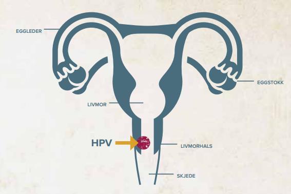 Effekt av Cervarix I finsk studie: beskyttelse mot 93% av alvorlige forstadier til livmorhalskreft uavhengig av HPV-type hos kvinner som ikke hadde HPV-infeksjon ved vaksinasjonstidspunktet (Lehtinen
