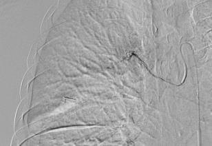 intercostalarterie Rød pil