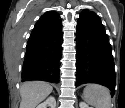 Blødning i thoraxvegg Han tok skikkelig i ved spirometrien og fikk etter hvert et betydelig hematom i