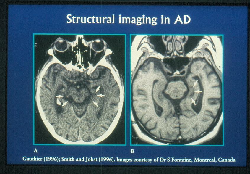 Differential diagnostikk Mental svikt