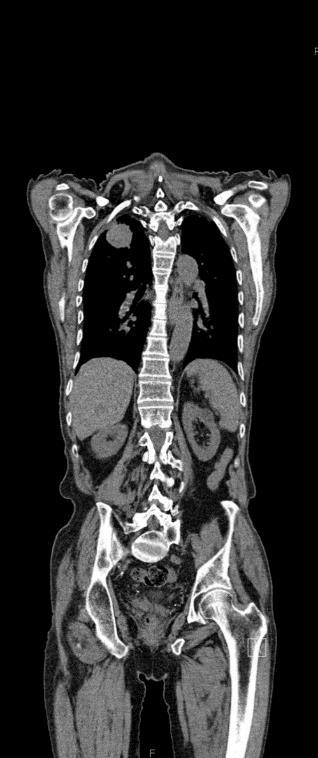 Hovedoppgave i medisin Bruteig et Ullern 2015 PET alene gir en dårlig anatomisk fremstilling av tumor (10).