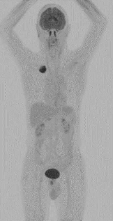 Denne bildemodaliteten kalles integrert PET-CT. Figur 1.6.1: Sammenligning av CT (t.v.), PET (i midten) og integrert PET-CT (t.h.). Bildene er hentet fra internundervisning med Kristin Nesgård.