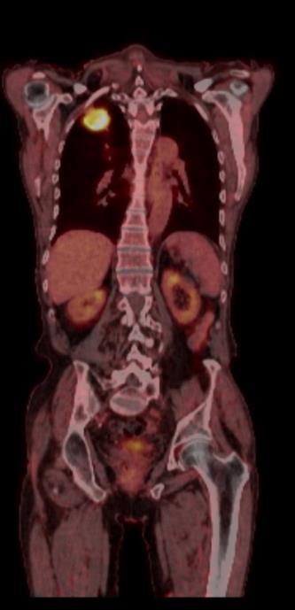 Det siste året før åpningen av PET-CT i Trondheim gjaldt dette ca. 100 pasienter. Den første pasienten som ble utredet med PET-CT ved St. Olavs Hospital fikk utført undersøkelsen 12.