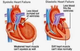 Ortostatisme ved hjertesvikt Hjertesvikt pga nedsatt pumpefunksjon på venstre hovudkammer medfører lågt blodtrykk og stor fare for ortostatisme.
