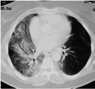 ødem osteoradionekrose Stråleforandringer i lunge: Tidlig skade: stråleindusert pneumonitt (kan behandles med