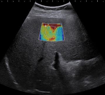 Ascites og fedme Overestimering Godt validert for fibrose Tilsvarende