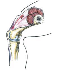 quadricepsaktivering Palpasjonssmerter medialt for patella (MPFL), under mediale patella og på laterale femurkondyl Oftest ved fall på flektert kne Symptomer Smerter Negativ SLR kne Behandling Total: