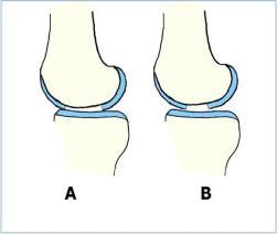 to load B: Small injury: Stable repair, no deformation when exposed to load Spesifikt for ACL -skader