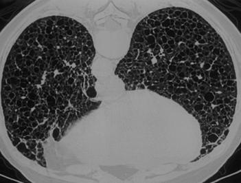 Tidligere frisk Ikke- røyker P- piller, ellers ingen faste medisiner Økende funksjonsdyspnø Spirometri som ved avansert KOLS Kvinne, 36 år Lymfangioleiomyomatose (LAM) Acute (AIP) Ideopathic