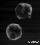 Wegener 1907-1990 ANCA = An-- nøytrofil cytoplasmiske an-stoffer Behandling ANCA er AutoAs (IgG) 2 vanligste: Proteinase- 3 (PR3) et canca