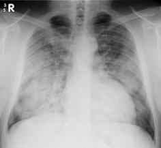 bronchiectasies Non- speciﬁc inters--al pneumonia (NSIP) MaVglass