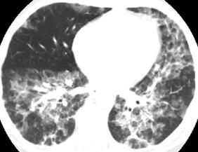 connec-ve -ssue disease Kan progrediere -l full ﬁbrose AkuV