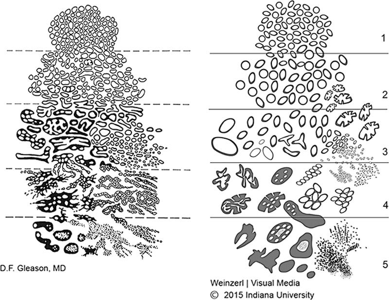 Normale PSA-verdier 40-49 år <,5 ng/ml 50 59 år < 3,5 ng/ml 60 69 år < 4,5 ng/ml 70-79 år < 6,5 ng/ml Tabell : Normal PSA verdi med økende alder. Kilde: Oncolex.