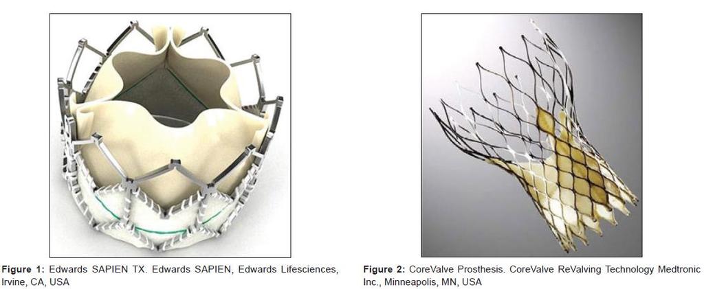 St.Olavs hospital bruker i dag 2 forskjellige levrandører av TAVI-klaffer. Edwards SAPIEN 3 er en metallstent med en biologisk klaff (perikard fra kalv) innsydd, den settes ut med ballong.