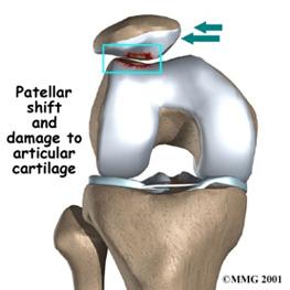 INNLEING Ved slitasje på leddbrusken i kneskjells leddet (patellofemoral leddet), kan ei halvprotese i de e leddet isolert være eit godt alterna v l ei total /heilprotese.