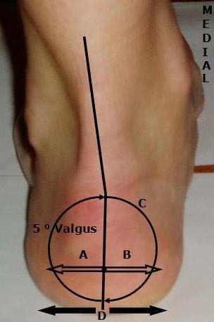 Test av subtalarleddet Subtalarleddet har en viktig funksjon i støtdempingsapparatet i foten. Os calcaneus har en 5 funksjonell valgus statisk i en "normal" fot.