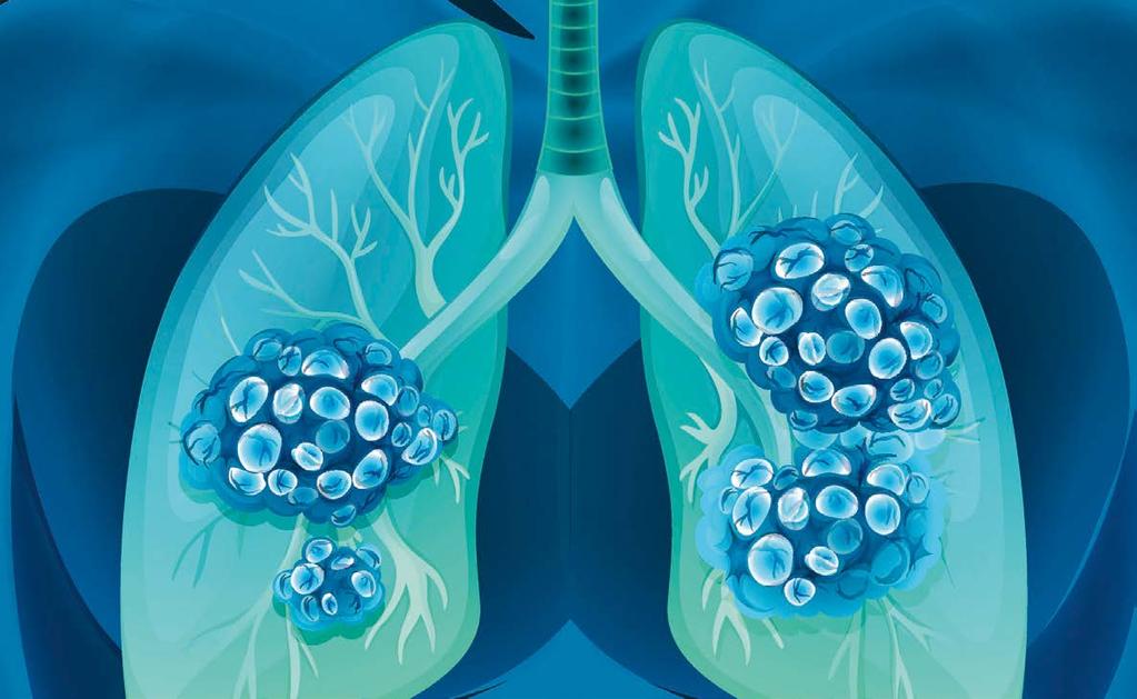 Nr. 3 2017 Lungekreftforeningen