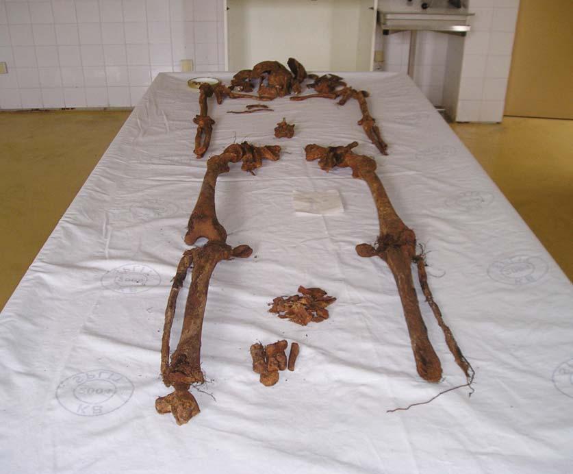 Duljina dugih kostiju: humerus = 32,5 cm, femur =46 cm. Na kostima se ne uočavaju specifična zaživotna traumatska oštećenja.