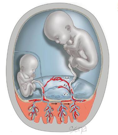 monokoriotiske tvillinger. Den skyldes dannelsen av anastomoser i deres felles placenta (44, s. 213). Blod transfunderer via kollateraler fra en donortvilling til en mottakertvilling.