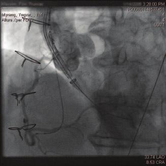 Behandlingen tilbys informerte og motiverte pasienter med symptomgivende alvorlig aortastenose eller -insuffisiens.