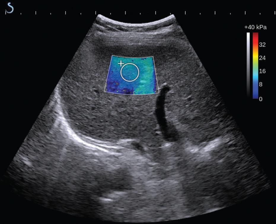 impulses deployed at increasing depths Supersonic shear imaging: a new technique for soft