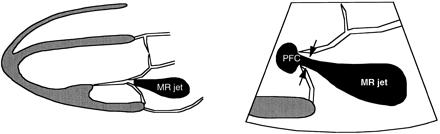 Gradering semikvantitativ (CF - Doppler) Vena Contracta Definisjon Smaleste diameter av lekkasje-jet