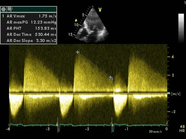 Gradering semikvantitativ (CW - Doppler) Trykkhalveringstid (PHT) Definisjon TG aorta/vv Fordeler PHT < 250 ms