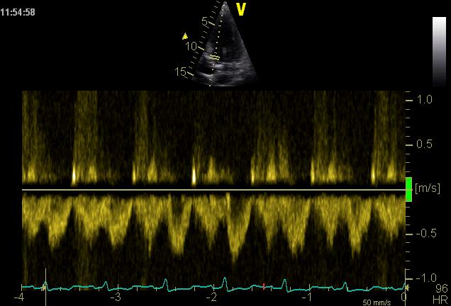 Gradering semikvantitativ (PW - Doppler) LVOT hastighet/sv