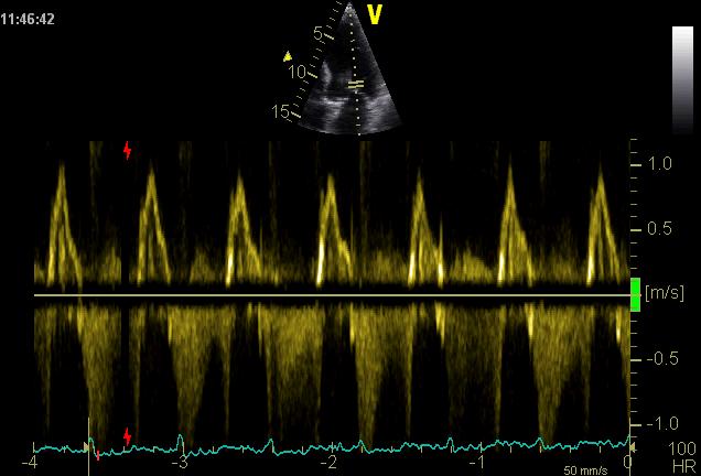 Gradering semikvantitativ (PW Doppler) Mitral-flow hastighet Definisjon