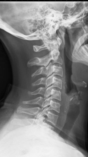 PASIENTINNSTILLING til SIDE: Bildet tas helst med pasienten stående eller sittende i rett sideplan. Pasienten retter opp nakken og senker skuldrene. Sentrer midt på halsen.