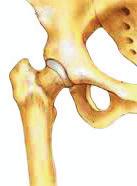 For mange er det ikke alltid samsvar mellom grad av smerter i hoften og røntgenforandringer. Flere faktorer kan disponere for utvikling av artrose, blant annet overvekt, alder, kjønn, arv og skader.