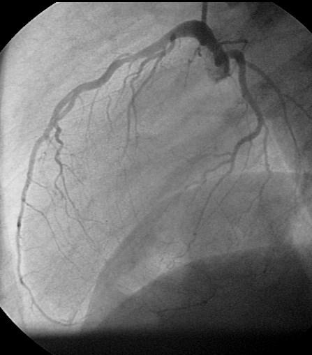 stenose? PCI?