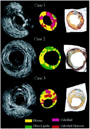 IVUS og virtual histology Karakteriserer vev basert på