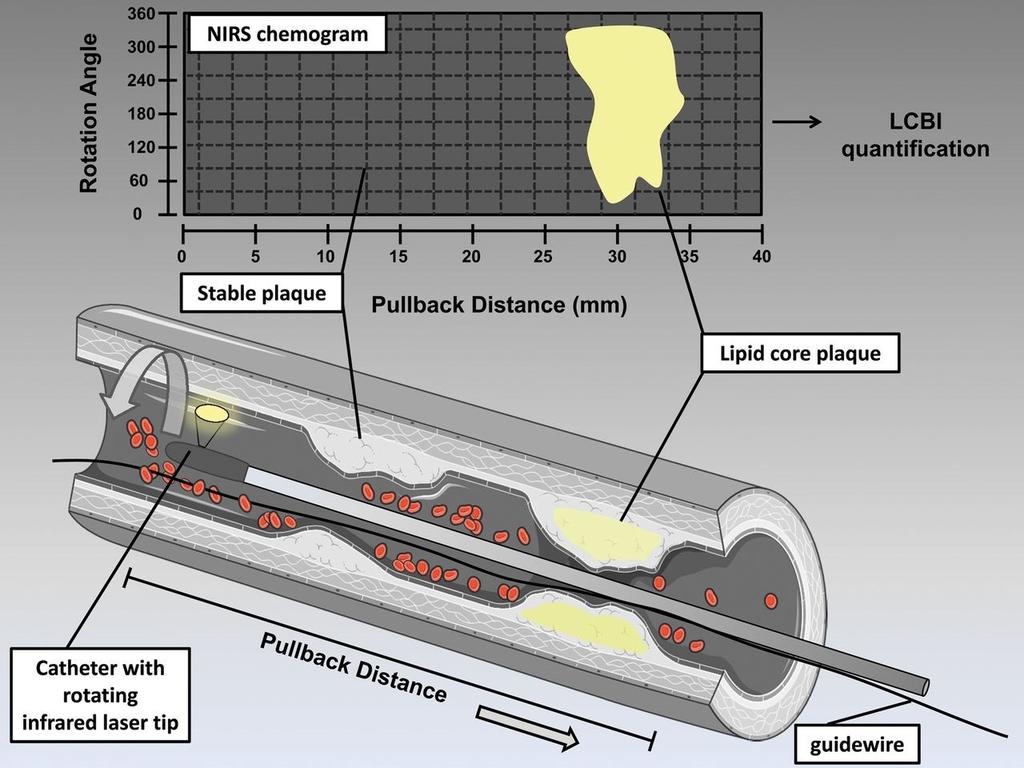 PLAKK-KARAKTERISERING Intracoronary NIRS catheter with a rotating infrared laser tip and resulting NIRS