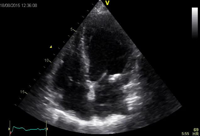 Aortastenose;