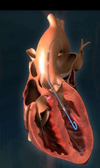 Impella generelle kontraindikasjoner Mural trombe i venstre ventrikkel Mekanisk aortaventil Alvorlig aortastenose